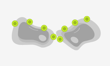 CLDN18.2 exposed due to cell polarity disruptions and structure loss